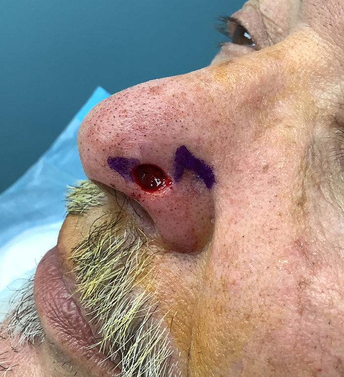 Left Nasal Tip Defect – Mohs Surgery After Image
