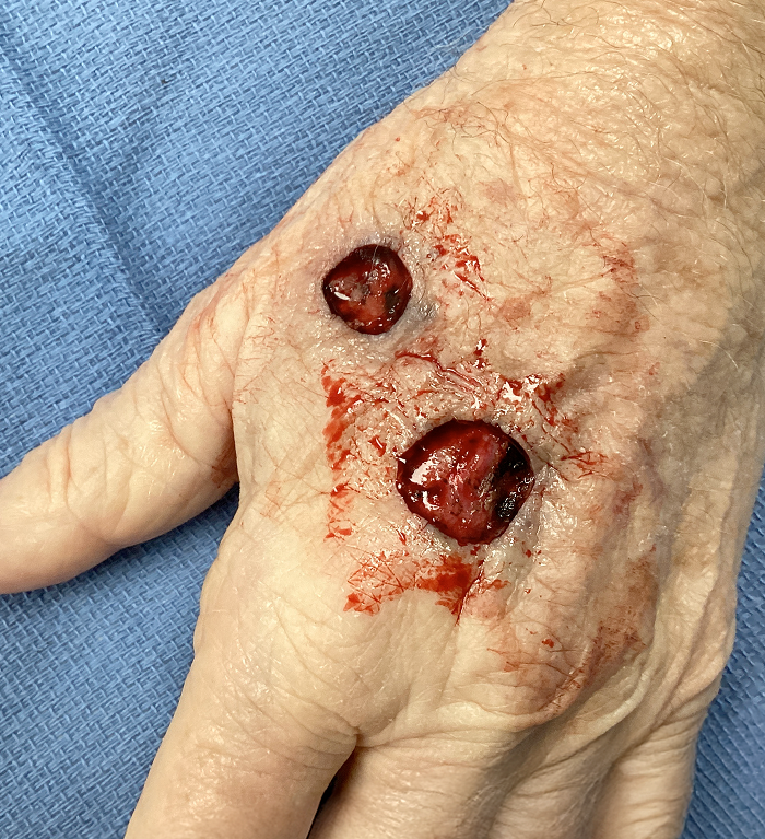 Left Hand Defect – Mohs Surgery After Image