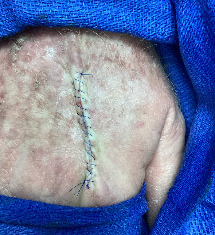 Right Hand Defect – Mohs Surgery Before Image