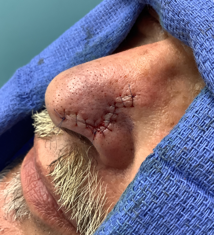 Left Nasal Tip Defect – Mohs Surgery Before Image
