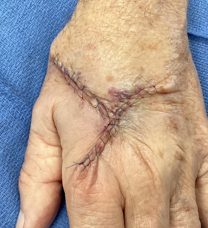Left Hand Defect – Mohs Surgery Before Image