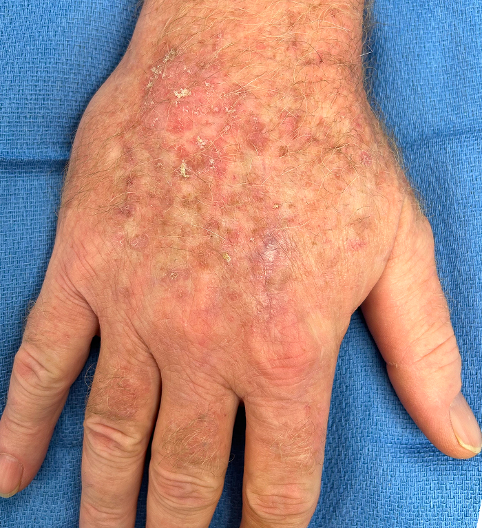 Right Hand Defect – Mohs Surgery After Image