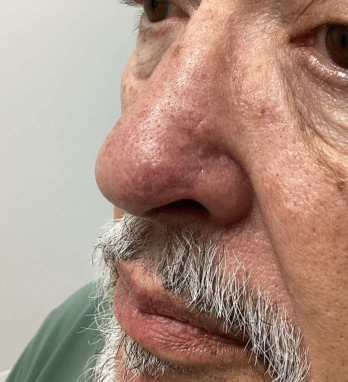 Left Nasal Tip Defect – Mohs Surgery After Image