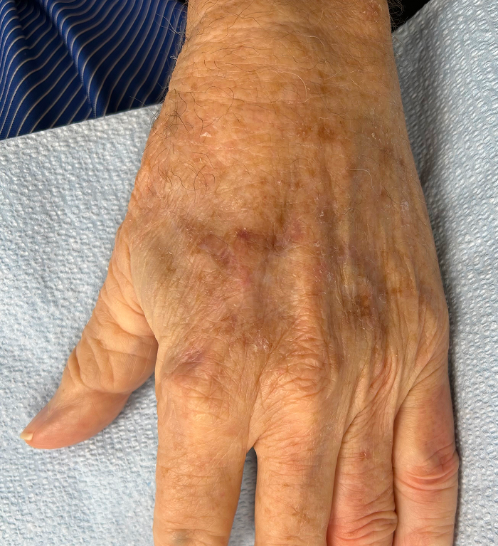Left Hand Defect – Mohs Surgery After Image